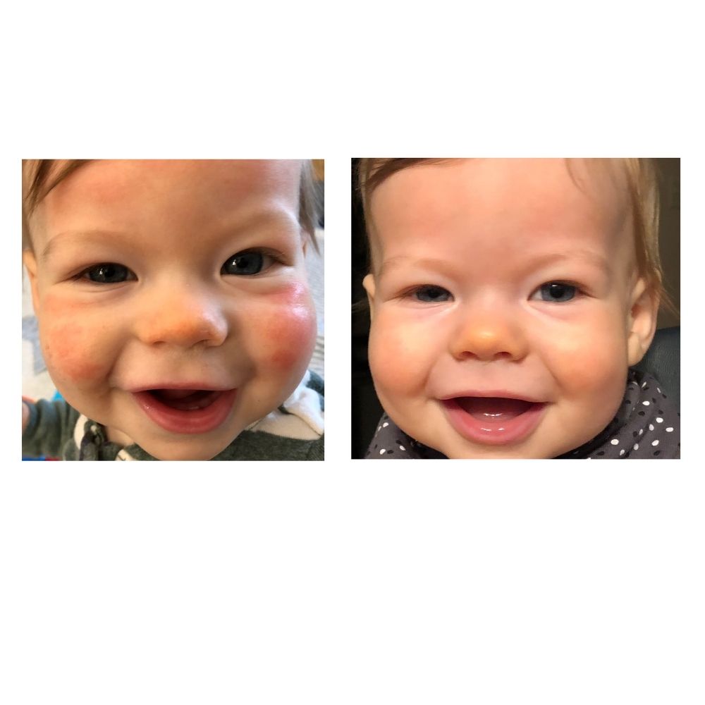 side by side before red itchy rash and after healed skin photo of baby eczema using USDA certified Organic Yore the Balm natural eczema remedy