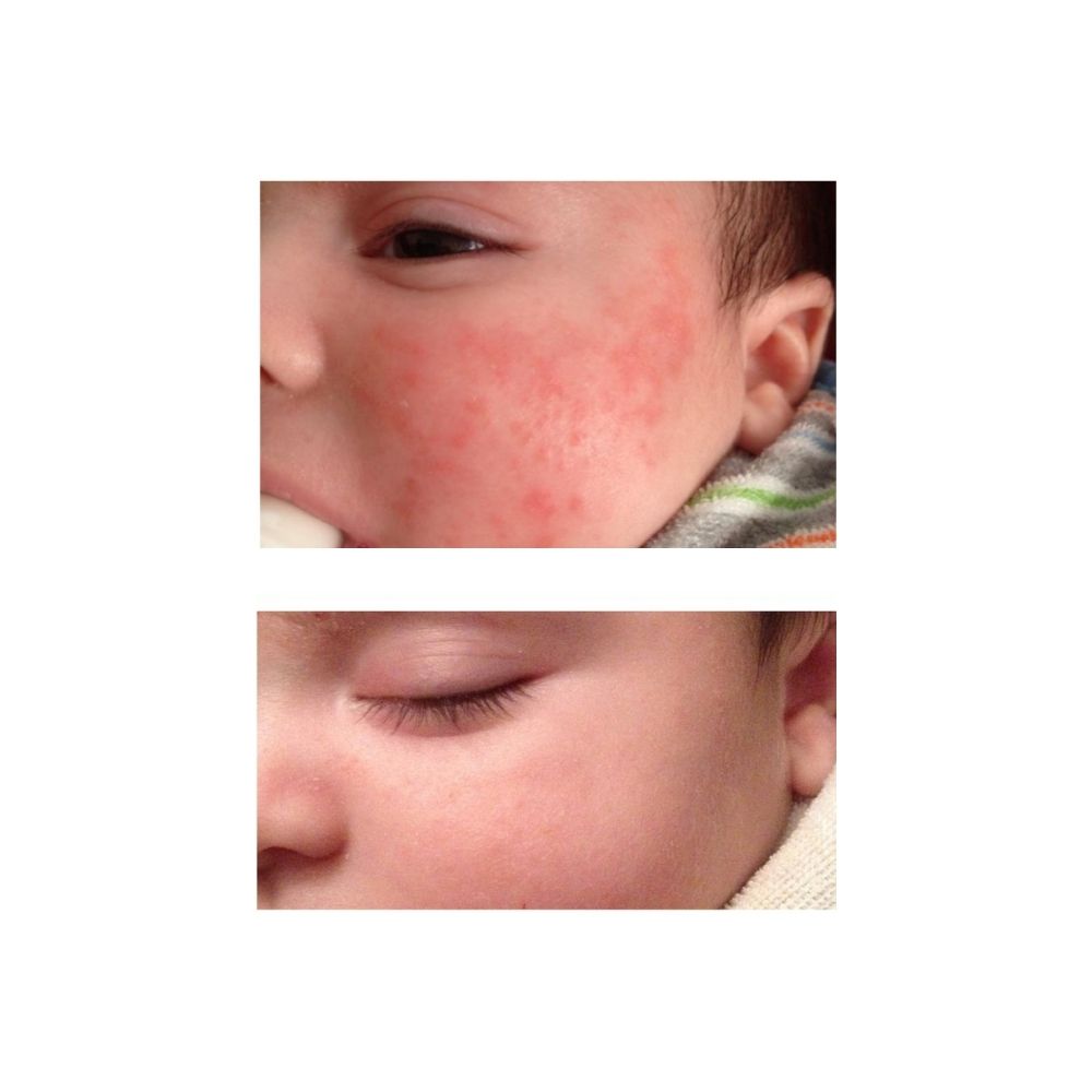 before photo of red baby eczema rash on face and after photo with calm healed skin after using organic natural Yore The Balm