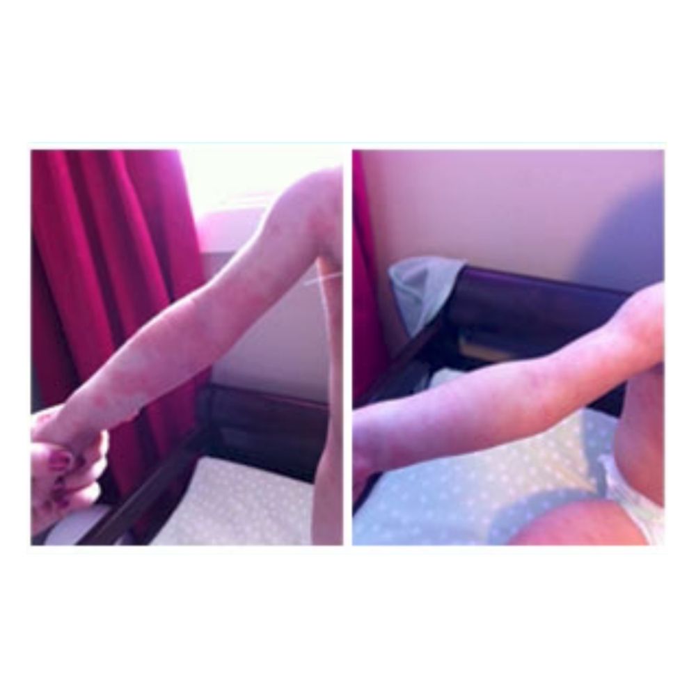 side by side photos of red eczema rash on baby arm and after calm arm using organic Yore The Balm natural cream