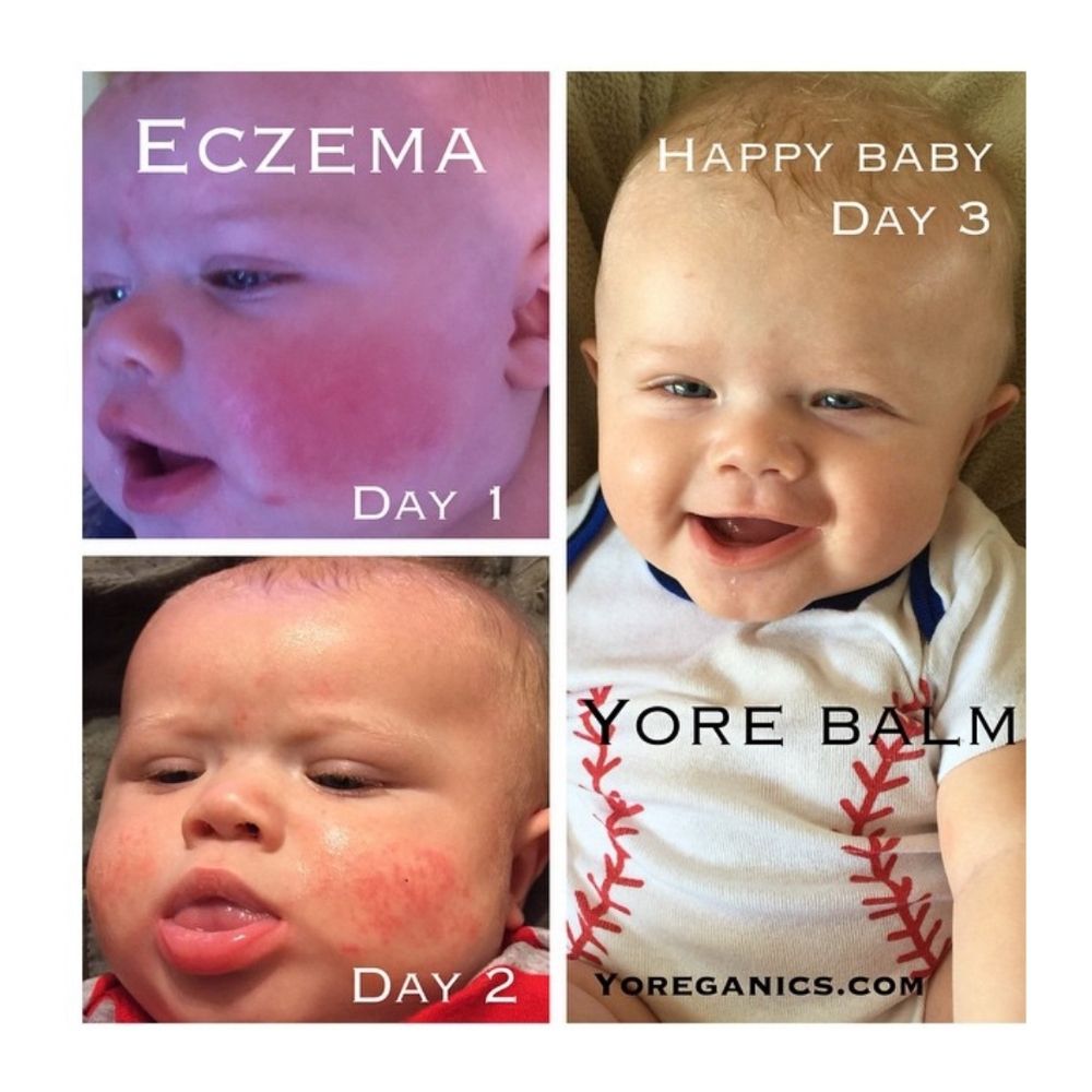 before and after comparison photos of baby face eczema after 3 days using Yore The Balm organic holistic natural remedy for eczema