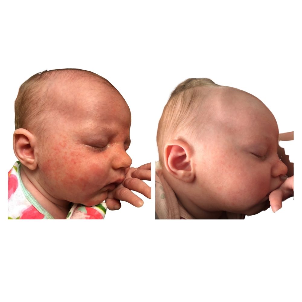 red inflamed eczema before photo and after using Yore The Balm organic cream to calm and soothe baby face after