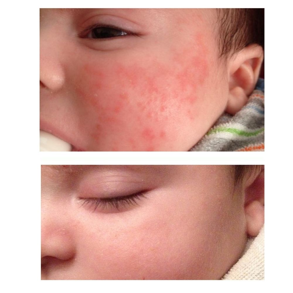 baby eczema on face before and after photo using Yore The Balm organic balm natural holistic eczema remedy